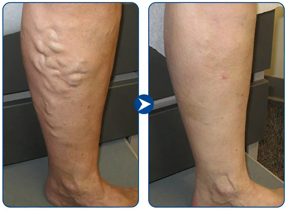 Avant et après — varices atténuées