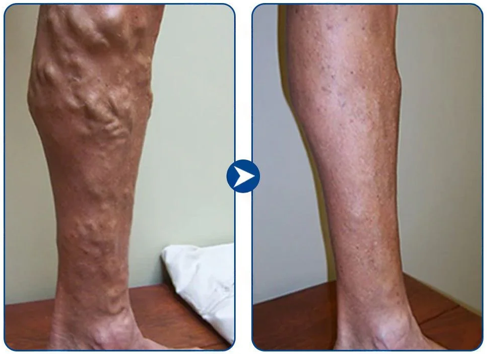 Avant et après VenoErase, mollet à J1 et J14